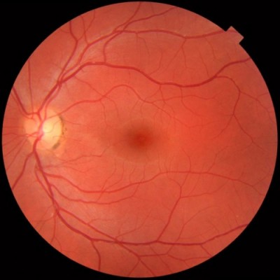 Eye disorder - Retinitis Pigmentosa a leading cause of blindness worldwide Eye disorder