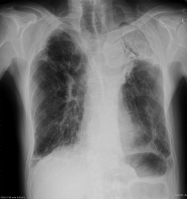 Aspergillosis - Aspergillosis