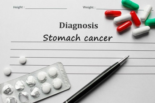 stomach cancer diagnosis - stomach cancer diagnosis