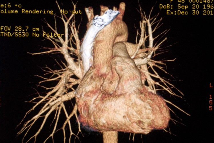 3DHeart-011411-001