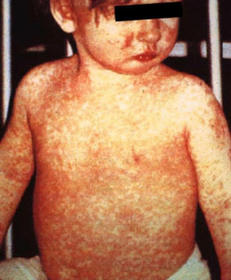 Child with a classic measles rash after four days.