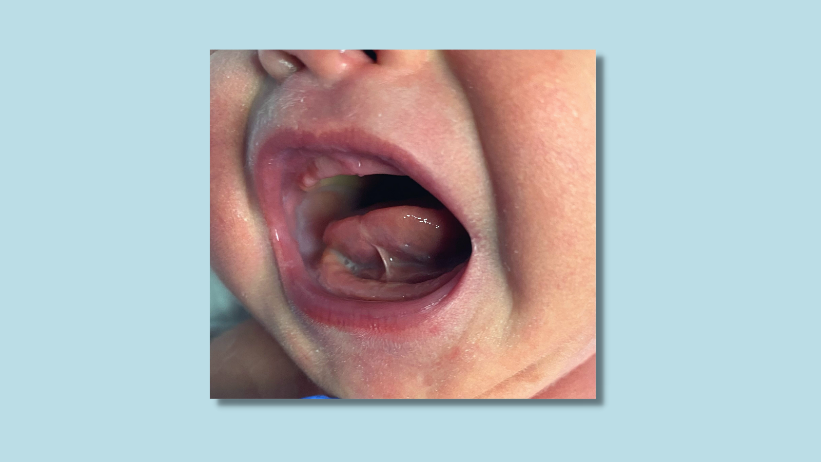 Tongue Ties 5 Children's Health Experts Weigh In