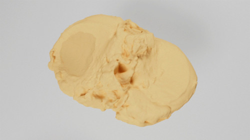 Revolutionising osteoarthritis treatment through bioprinting