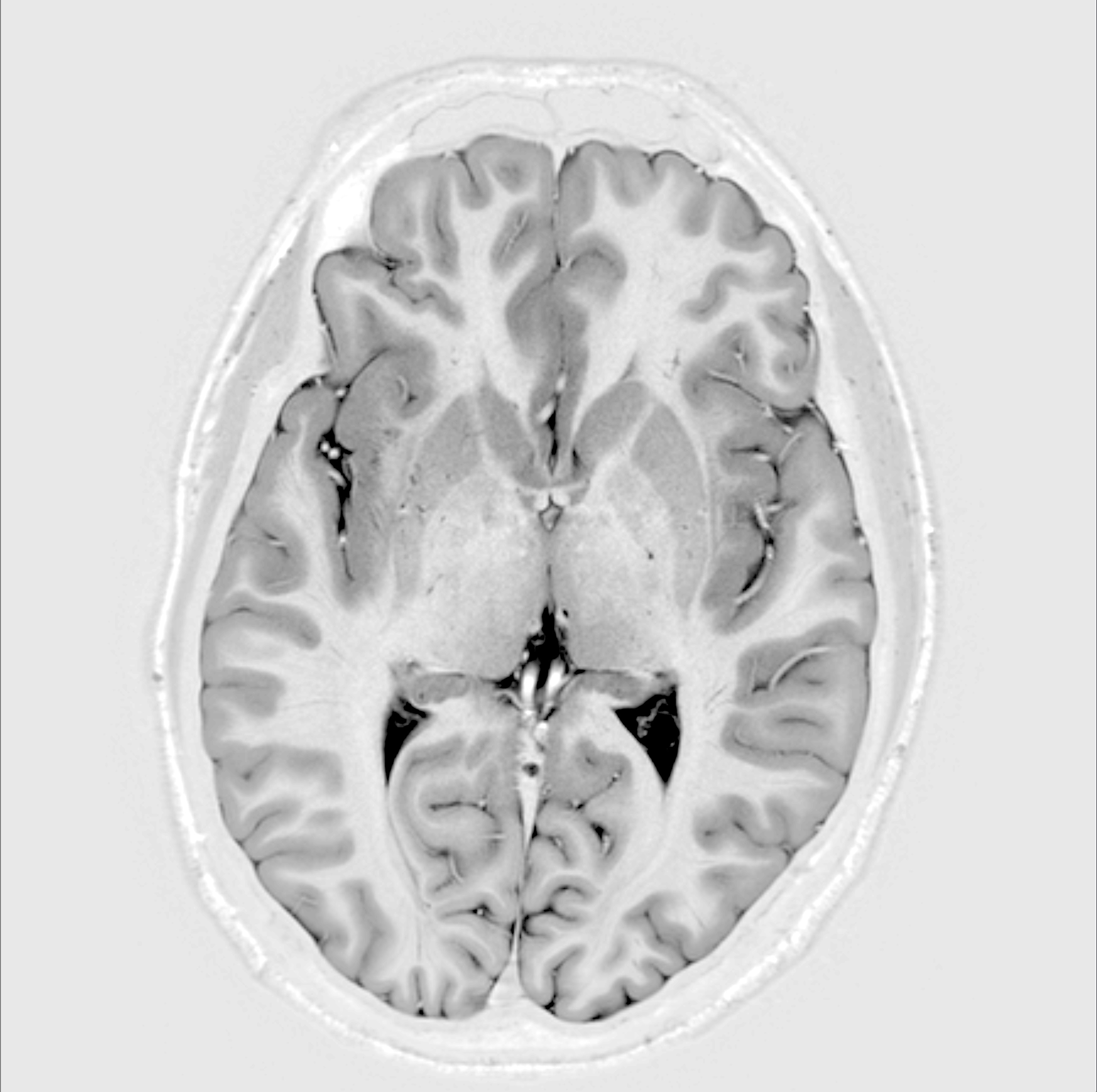 Failure Bitmap Brain scans to give crucial insight into childhood genetic disease