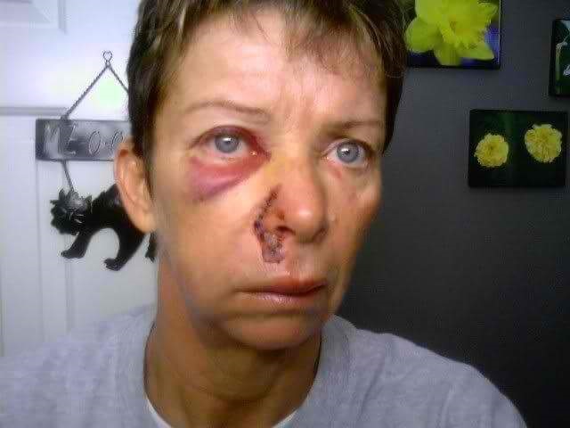 Cheryl after the motorcycle incident.