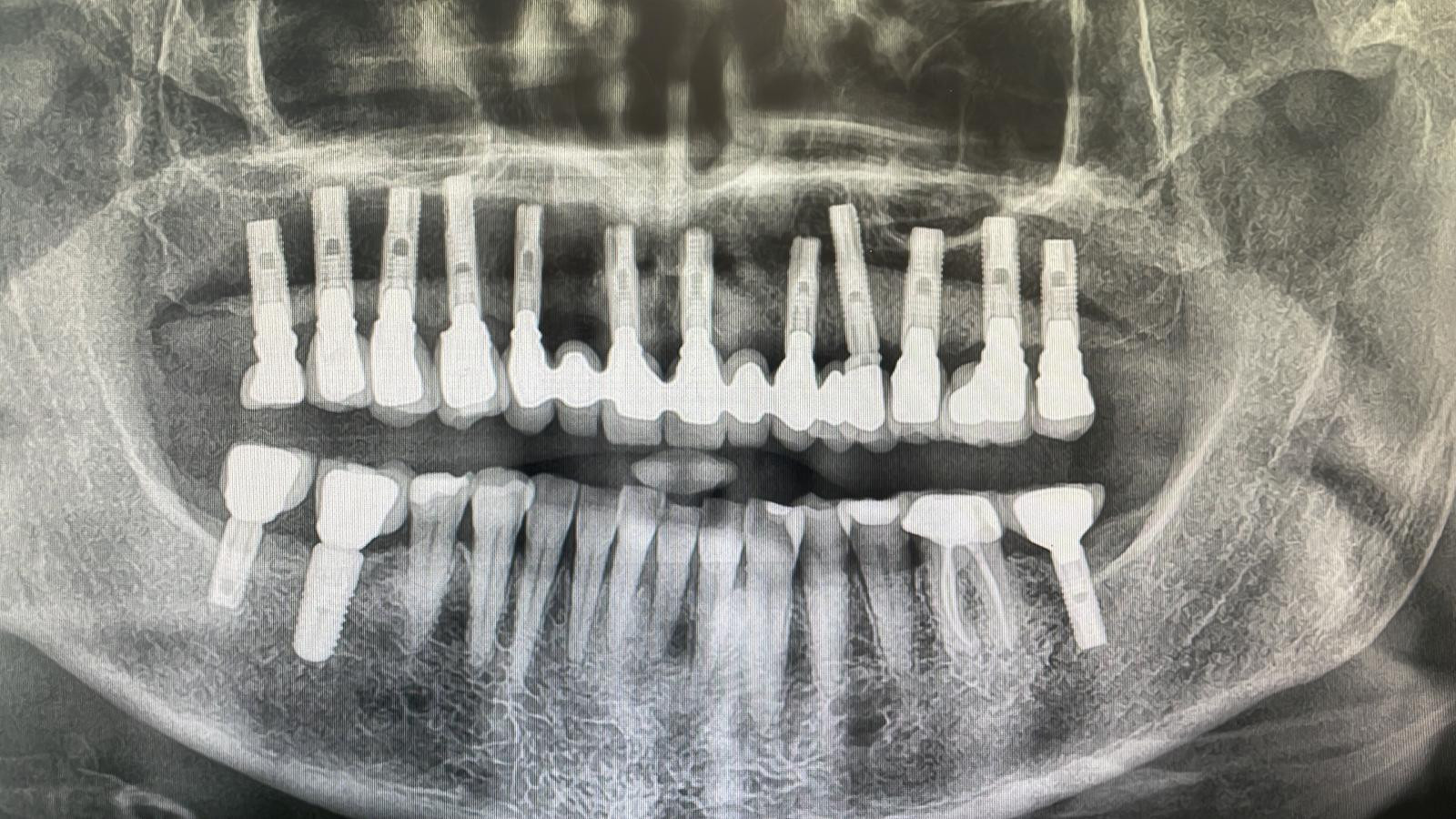Xray of implants 23 May 2023