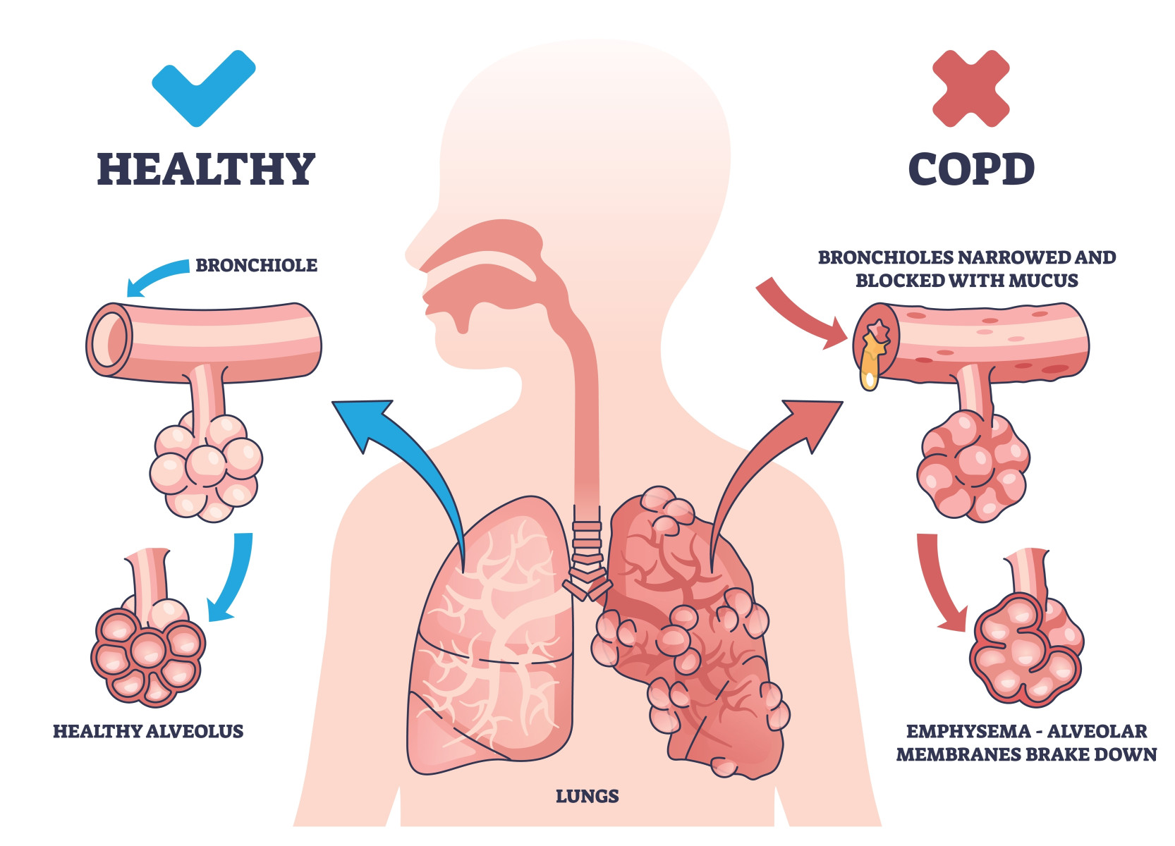 All about  
breathing wellness for older adults  
Holistic Copd Relief thumbnail