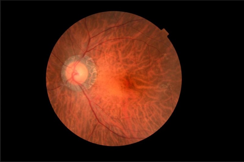 A new vision for diabetic eye exams in primary care offices