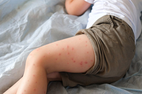 Why measles vaccines still matter today