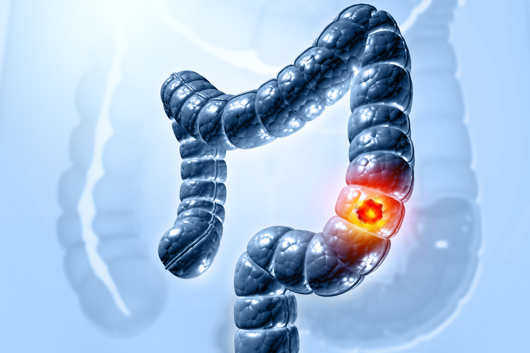 Colorectal Cancer: Deadliest for Under 50s