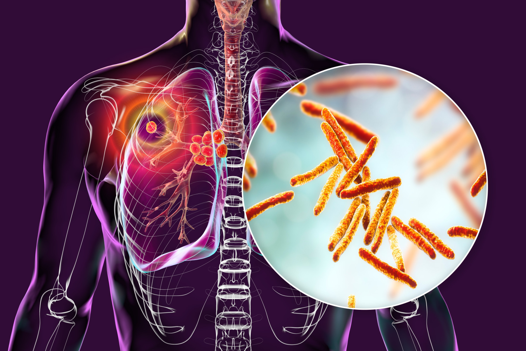 Tuberculosis: Symptoms, Spread and Safety Tips