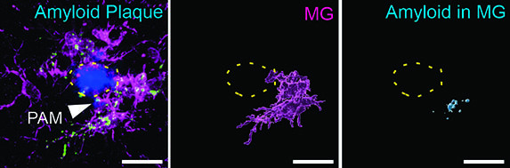 Cedars-Sinai investigators boosted ACE expression of microglia (in magenta) to clear amyloid plaques (in blue) associated with Alzheimer’s disease. Image by Cedars-Sinai.