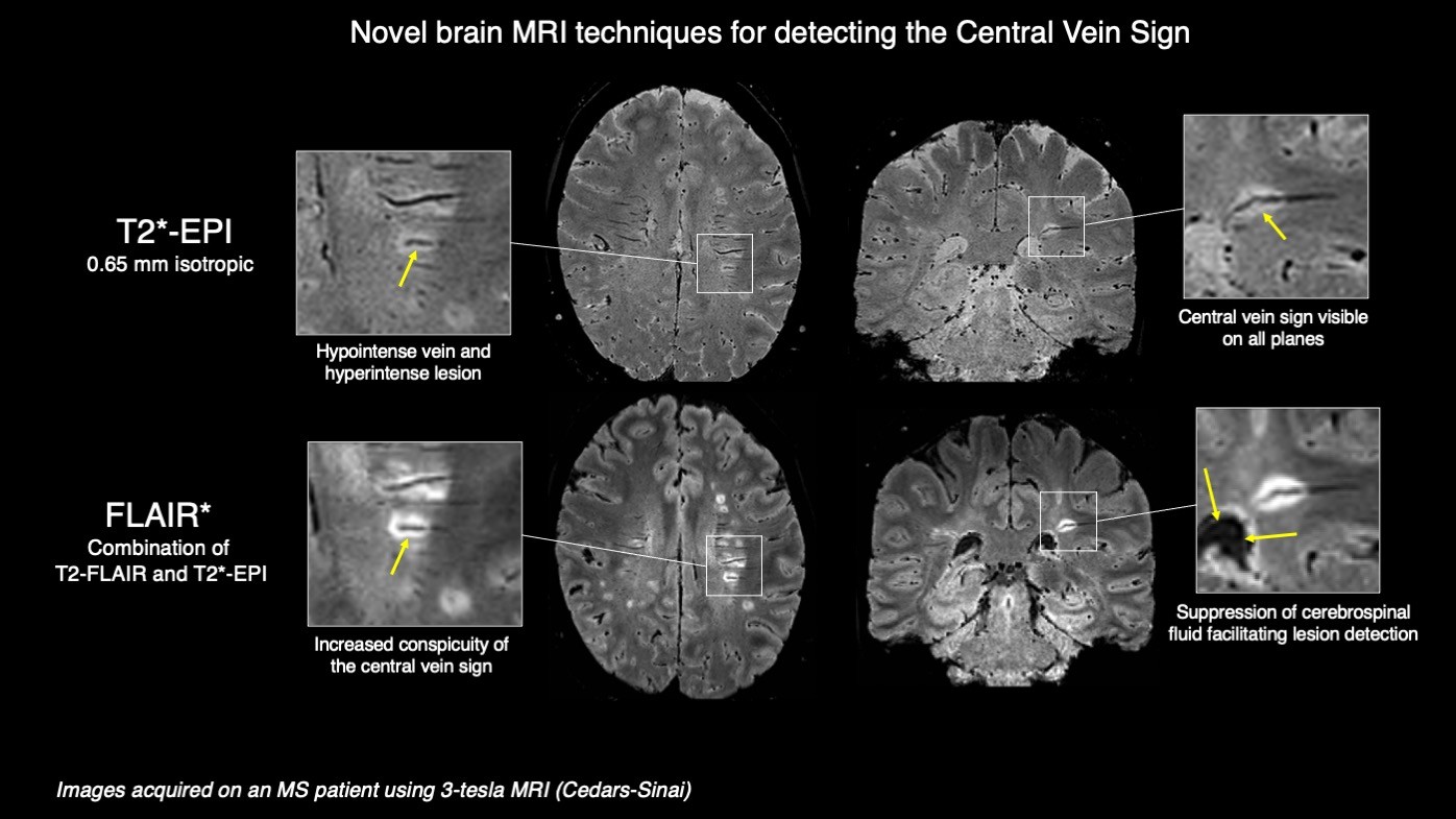 Lesion On Mri Scan Lesion On Mri Scan