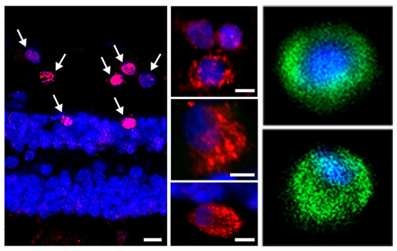 Chlamydia pneumonia detected in the human retina by specific monoclonal antibody (red), and DNA probe (green) and nuclei (blue). Image courtesy of Maya Koronyo-Hamaoui.