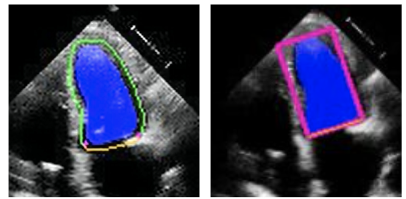 Echocardiogram image demonstrating myocardial strain measurement.