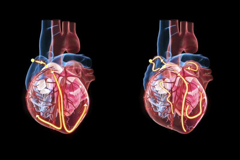 The yellow lines demonstrate the electrical system of the heart. The heart at right shows an irregular heartbeat and atrial fibrillation. Image by Getty.