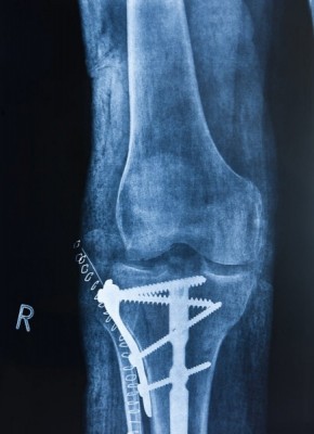 photo of fractured bone