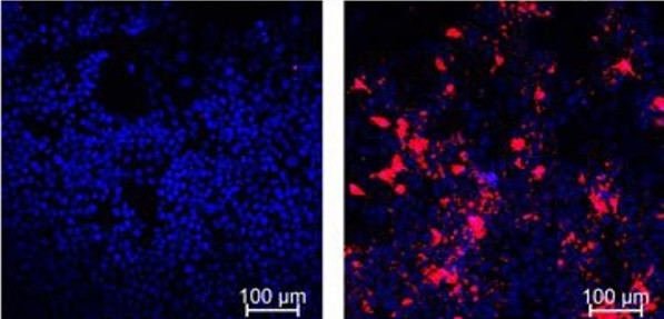 Comparison of colorectal cancer cells treated in culture with micelles containing only a chemo drug, left, to cells treated with the fully loaded RNA micelles, where red dye shows an enzyme present when cells undergo programmed cell death.