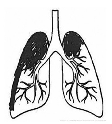 For the visual measure, patients were asked to color in the proportion of their own lungs that they perceived to be diseased. Image: Charles Emery
