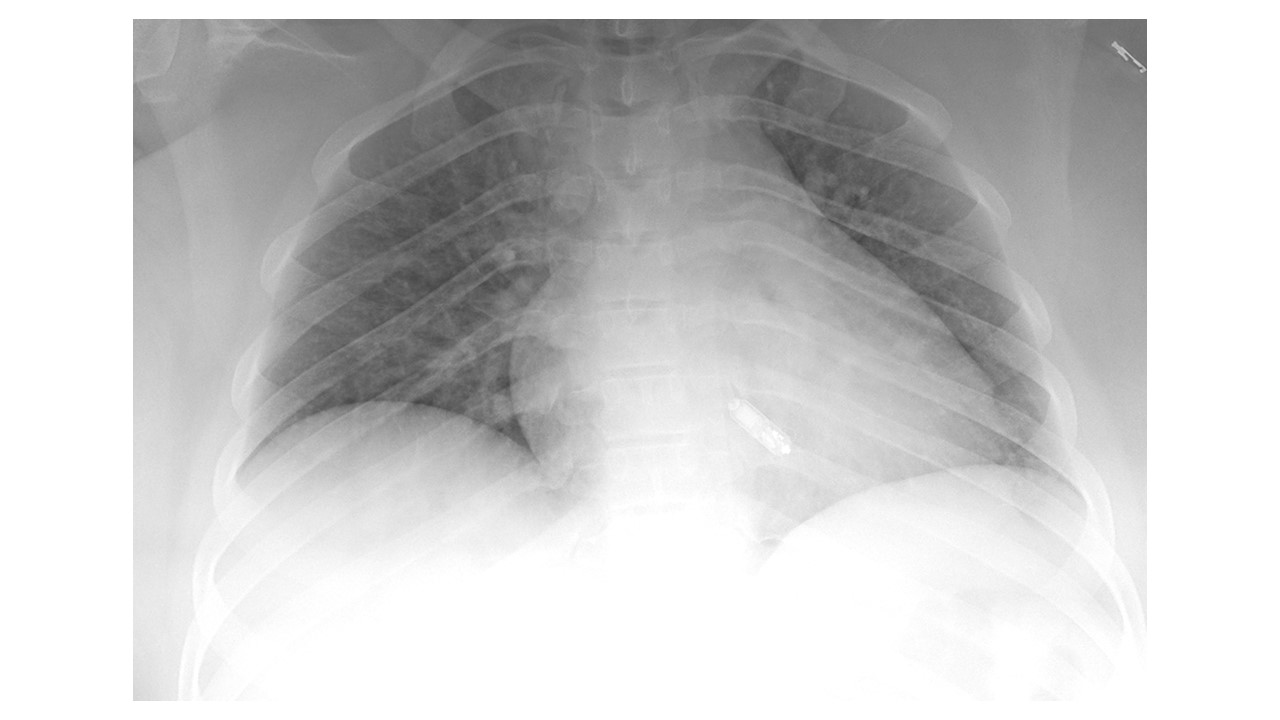 Leadless Pacemaker Implant Procedure Available