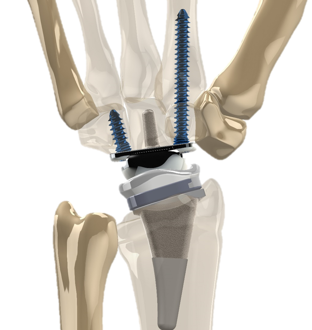 FDA Approves New Total Wrist Replacement Device FDA Approves New Total Wrist Replacement Device