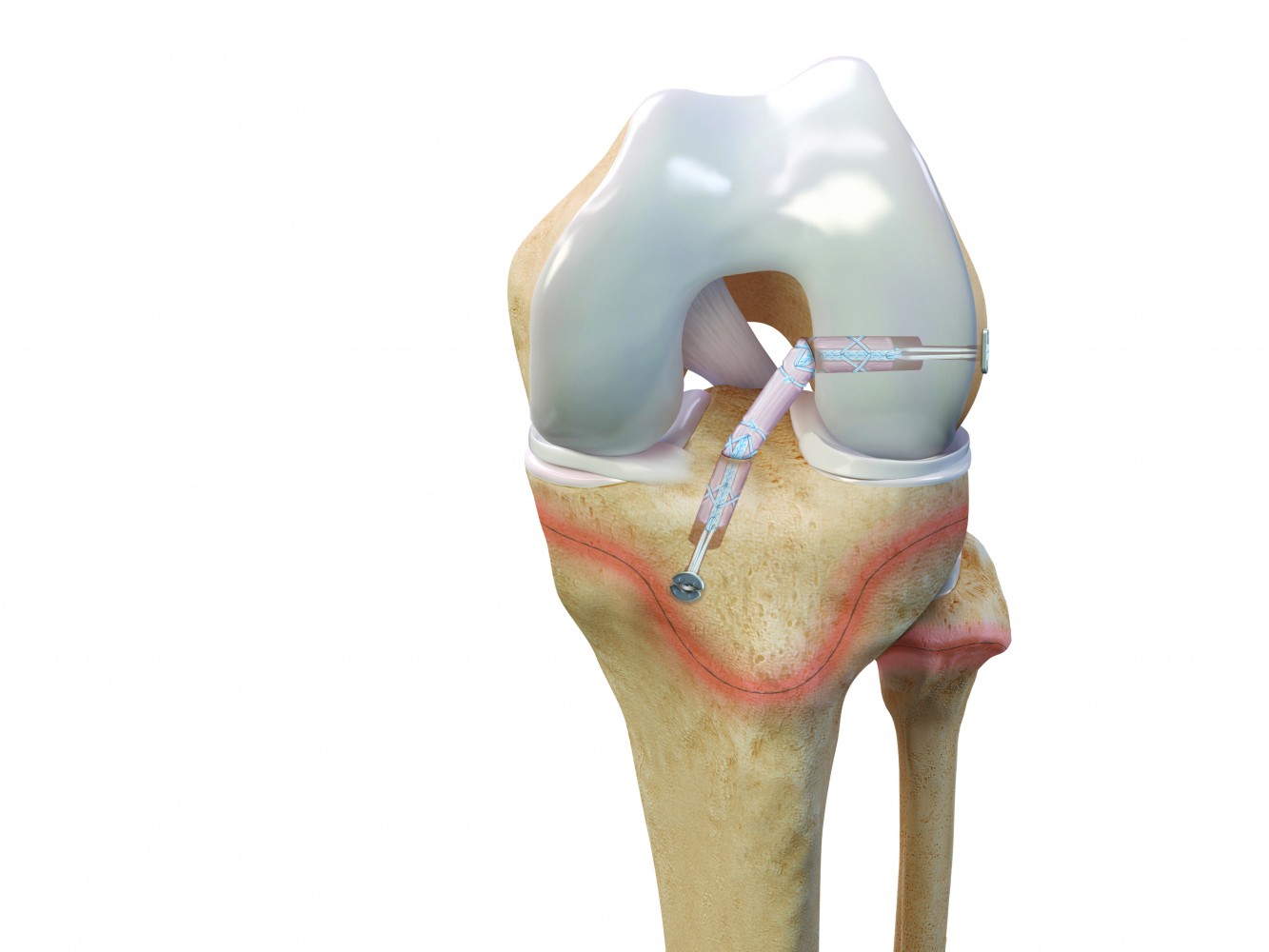 FDA Provides Clearance of First-Ever Device for ACL Reconstruction in ...