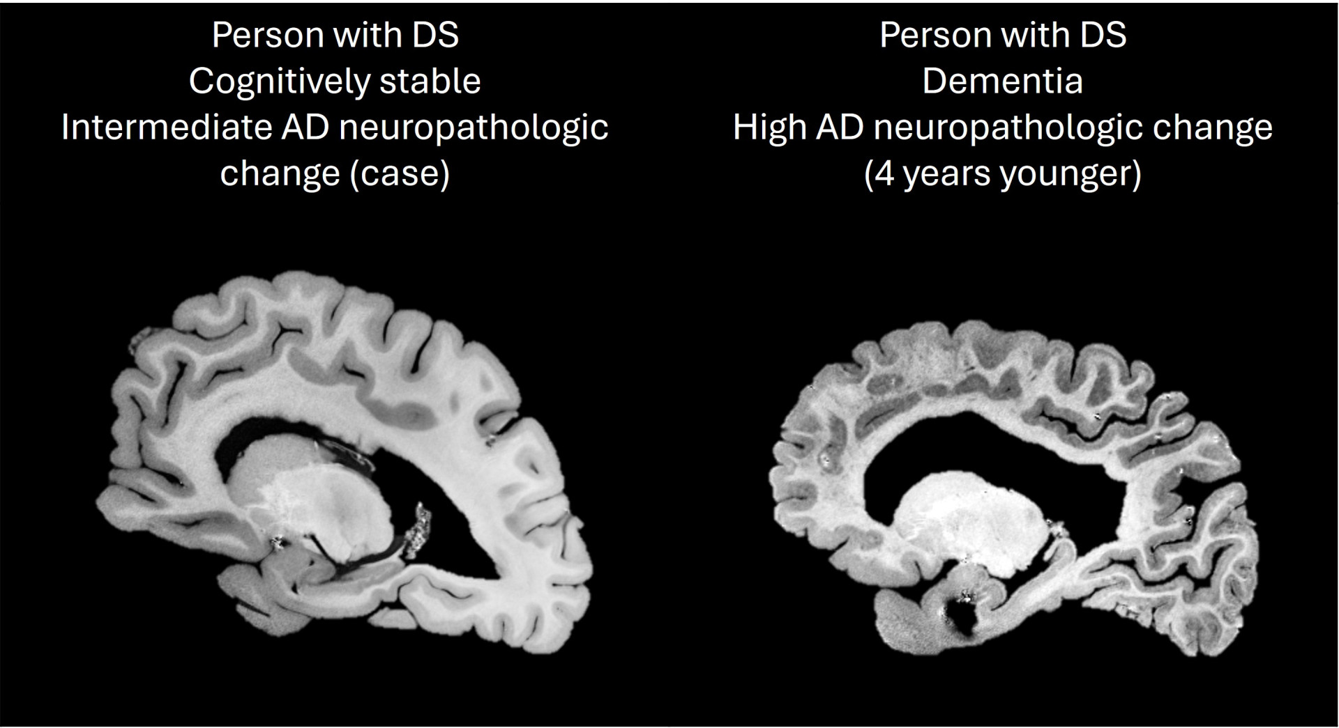Audible Disease Dementia DM-1 ノイズマシン Audible Disease