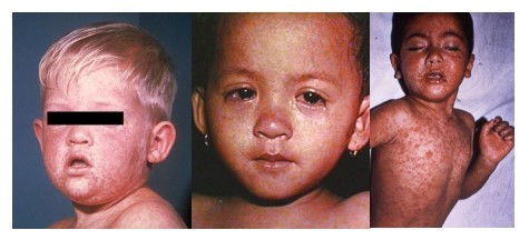 Measles