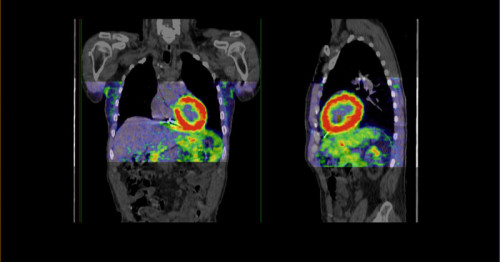 PET-Tracer in Entwicklung von Bayer erreicht primäre Endpunkte in Phase-III-Studie