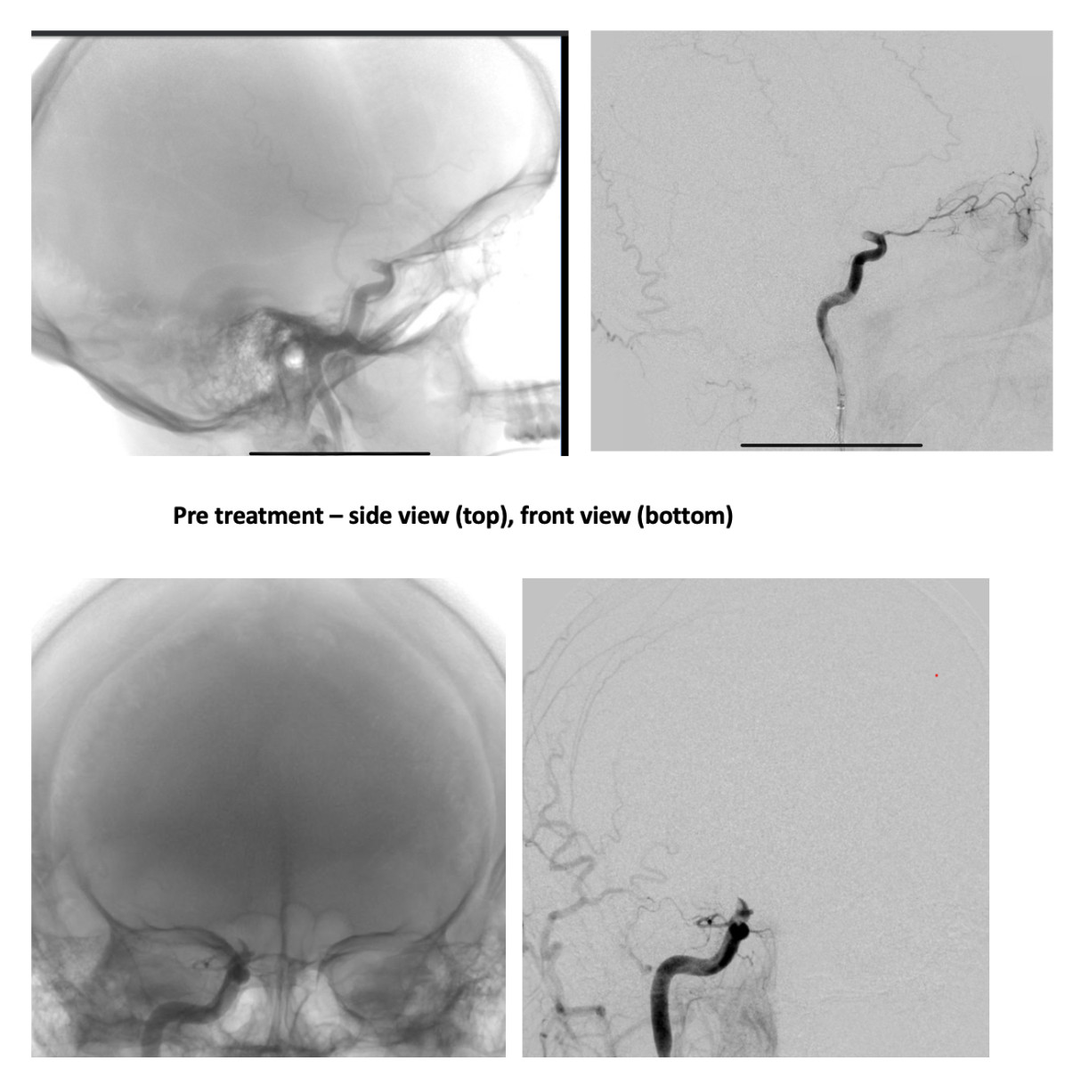 Pre treatment imaging from stroke