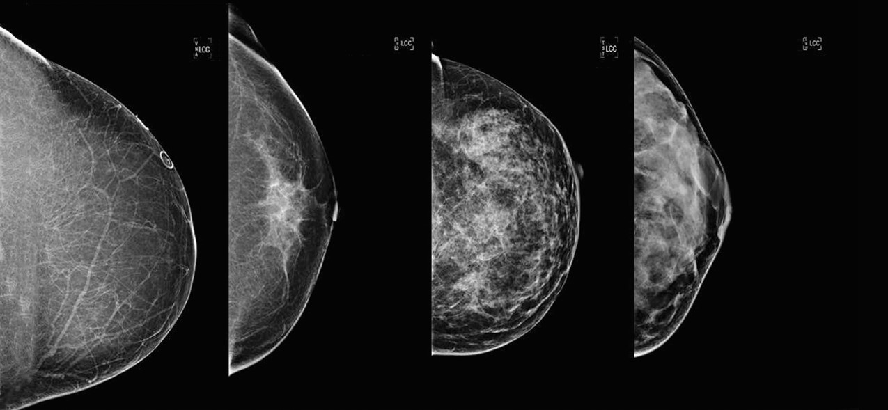 The four categories of breast density, in order from A to D.