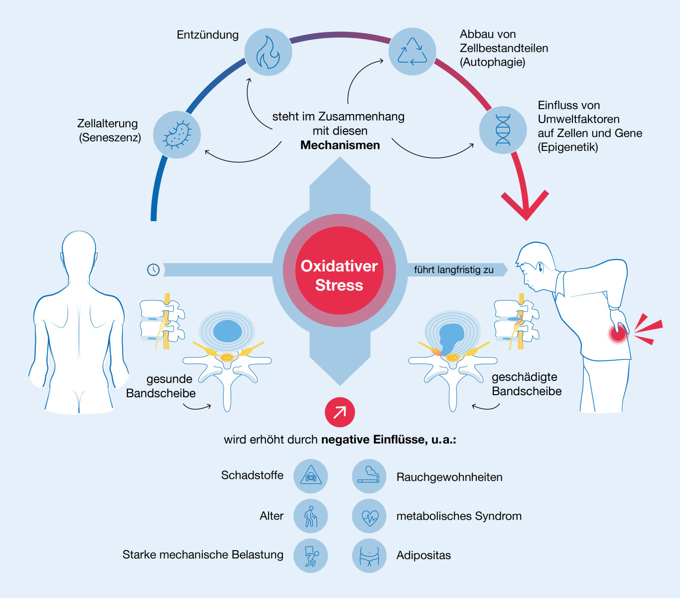 Infografik: Auswirkungen von oxidativem Stress auf die Bandscheiben